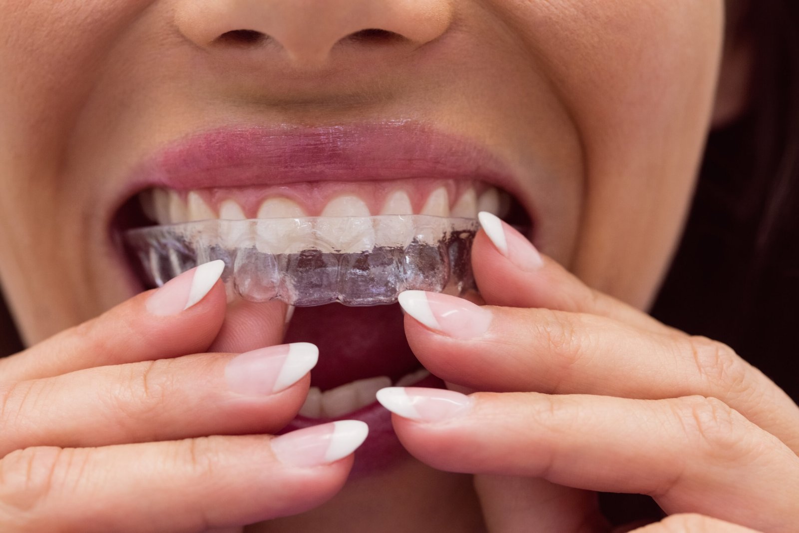 INVISALIGN ALIGNERS